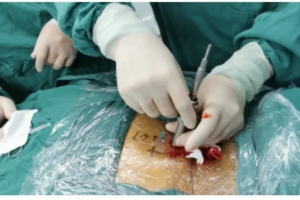 A Case Share - Full Visible Endoscopic Posterior Decompression For C5-6 and C6-7 Double-segment Stenosis