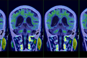 臨床基礎齊發力 阿爾茨海默病雙突破